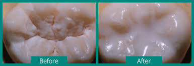 teeth whitening irvine